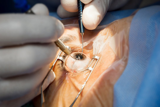 ADVANCE CERTIFICATE COURSE IN PHACOEMULSIFICATION